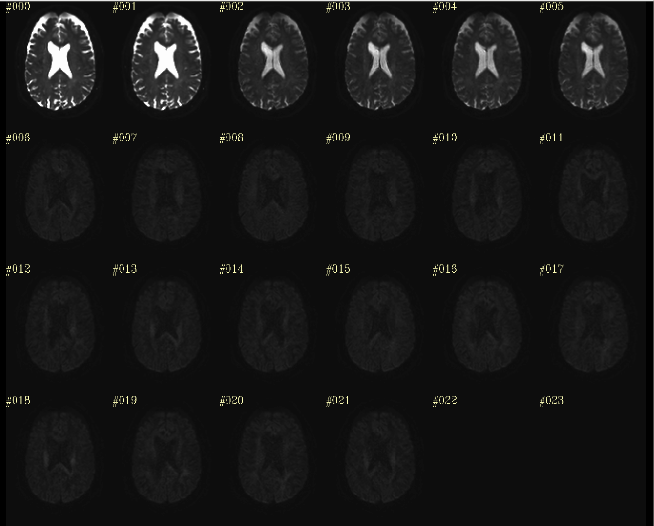 Processed DWI Axial