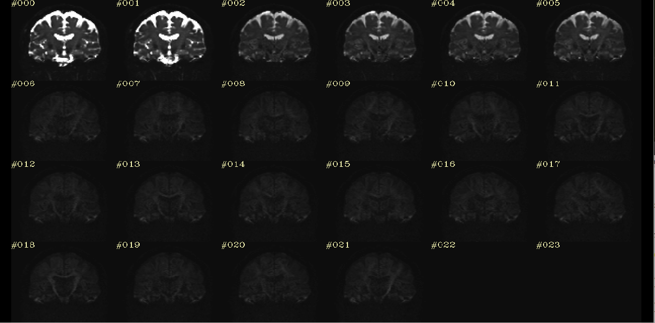 Processed DWI Coronal