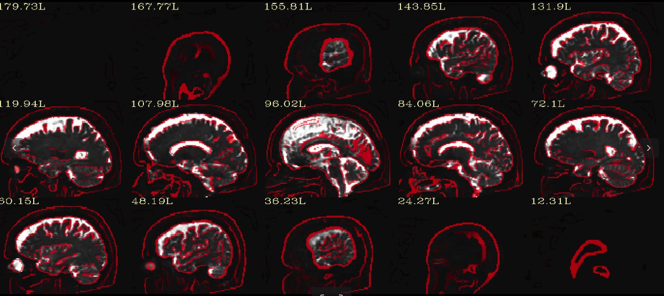 EPI DISTORTION CORRECTION QC Sagittal