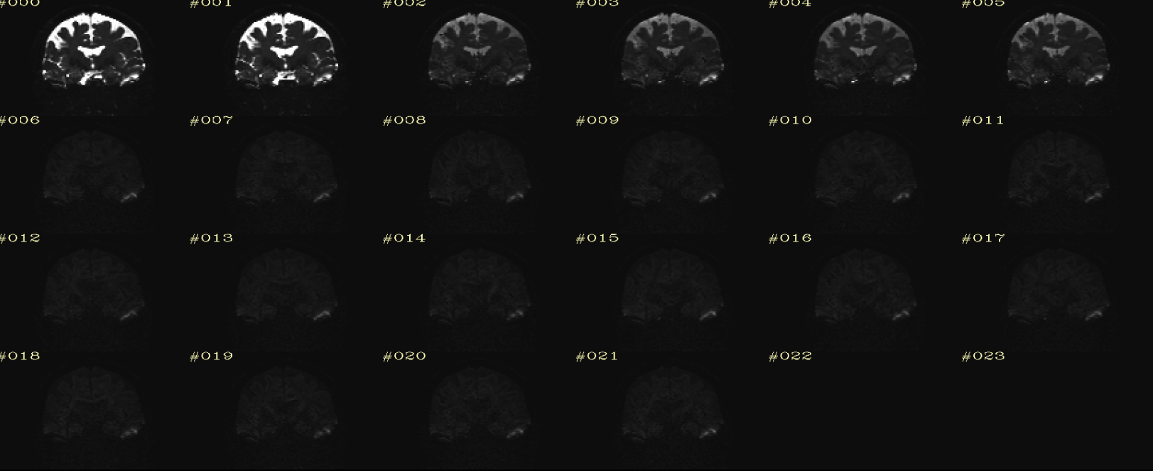 raw dwi Coronal