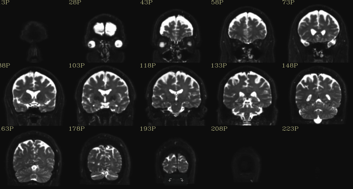 structural Coronal